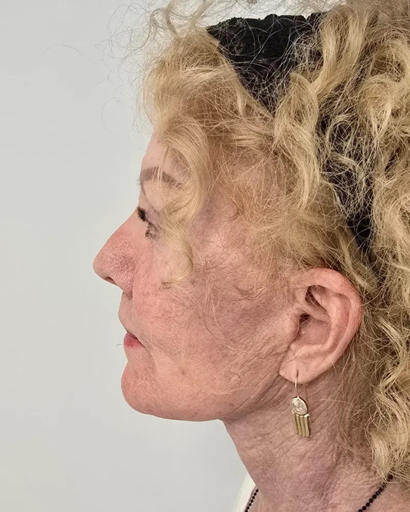 Deep plane λίφτινγκ και lip lift και λίφτινγκ μετώπου και φρυδιών: 1 μήνας μετά την επέμβαση, προφίλ αριστερό – γυναίκα 70+…