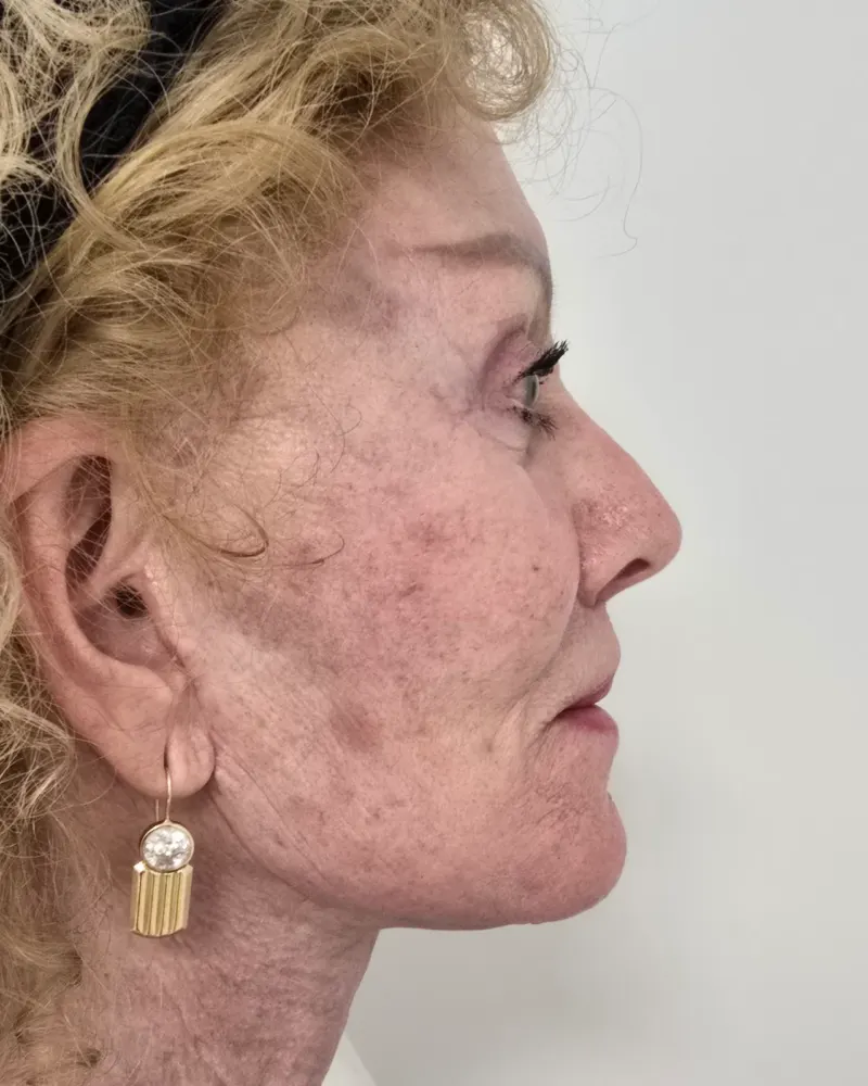 Deep plane λίφτινγκ και lip lift και λίφτινγκ μετώπου και φρυδιών: 1 μήνας μετά την επέμβαση, προφίλ δεξιά – γυναίκα 70+ ετών