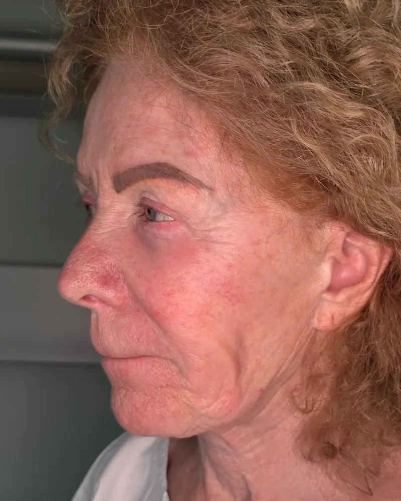 Deep plane λίφτινγκ και lip lift και λίφτινγκ μετώπου και φρυδιών: πριν την επέμβαση, λοξή αριστερή – γυναίκα 70+ ετών
