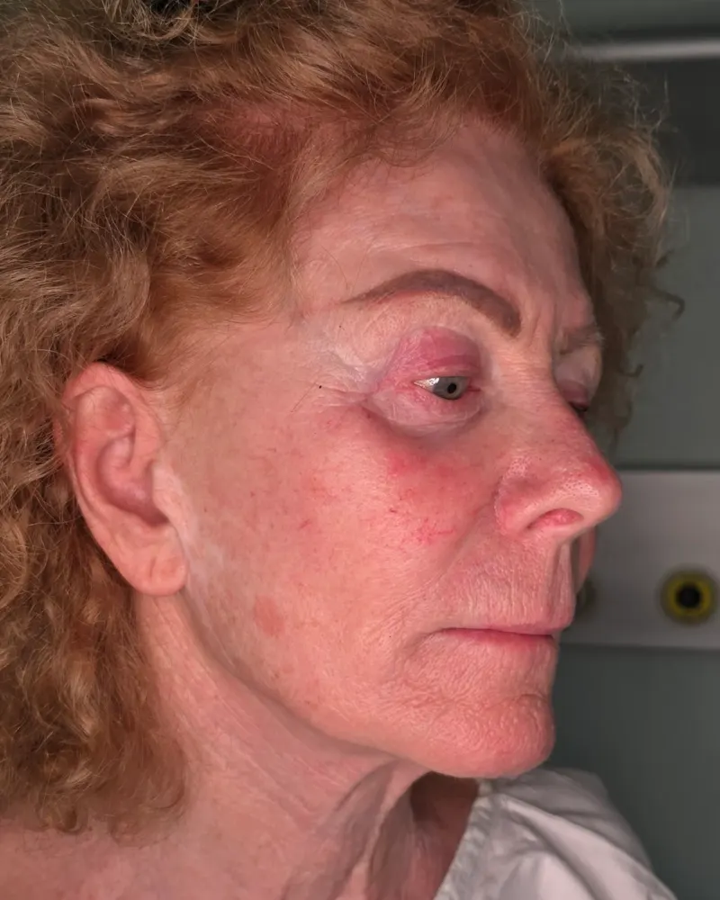 Deep plane λίφτινγκ και lip lift και λίφτινγκ μετώπου και φρυδιών: πριν την επέμβαση, λοξή δεξιά – γυναίκα 70+ ετών