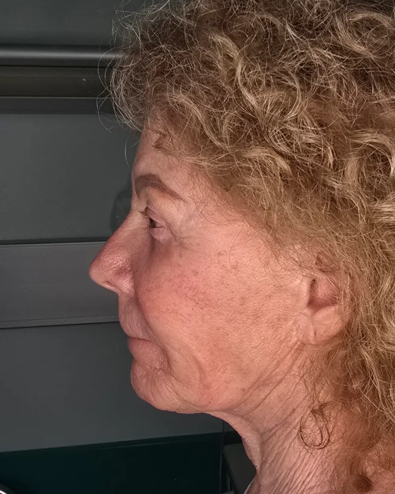 Deep plane λίφτινγκ και lip lift και λίφτινγκ μετώπου και φρυδιών: πριν την επέμβαση, προφίλ αριστερό – γυναίκα 70+ ετών