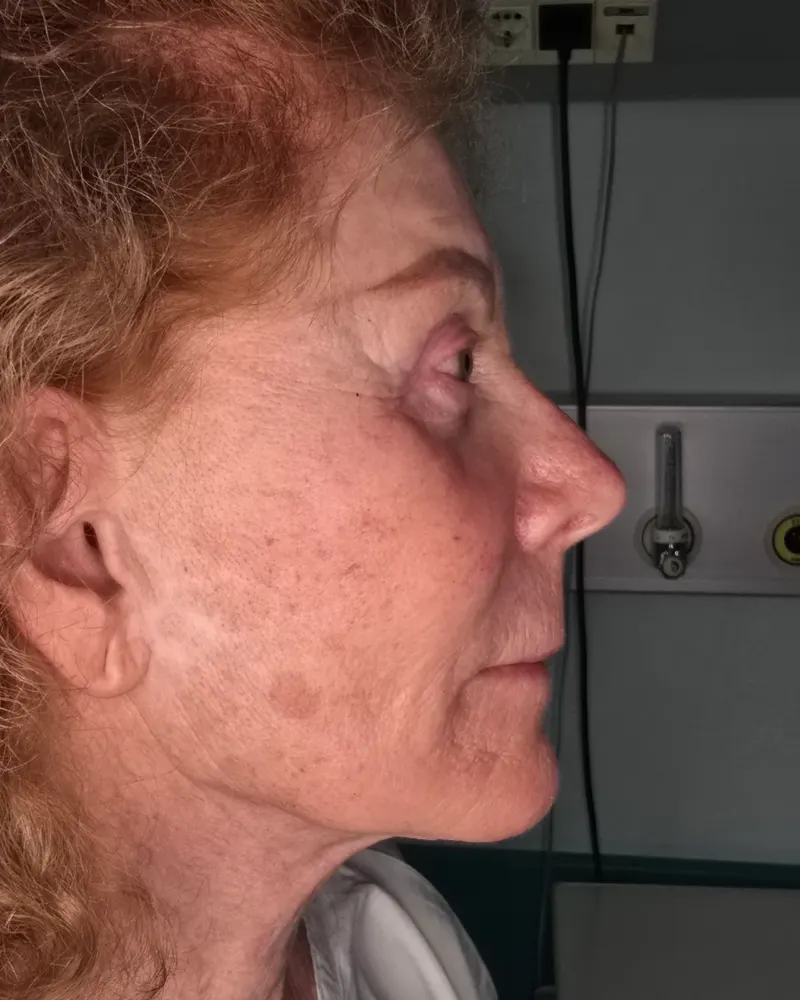 Deep plane λίφτινγκ και lip lift και λίφτινγκ μετώπου και φρυδιών: πριν την επέμβαση, προφίλ δεξιά – γυναίκα 70+ ετών