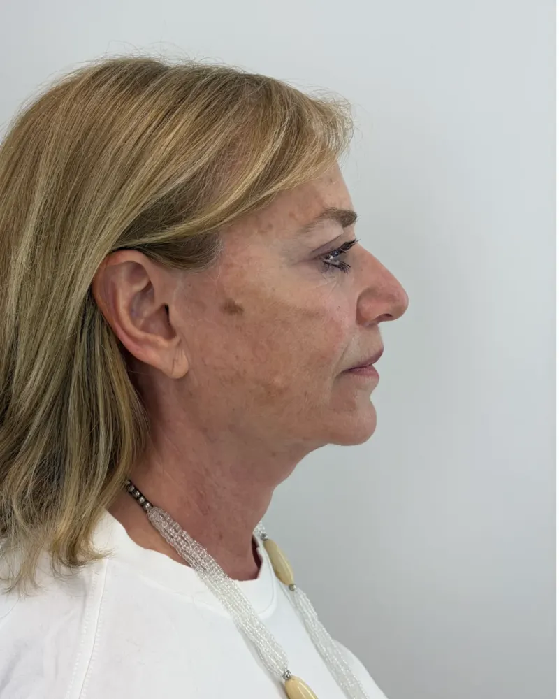 Deep plane λίφτινγκ και lip lift και βλεφαροπλαστική άνω βλεφάρων: 3 έτη μετά την επέμβαση, λοξή δεξιά – γυναίκα 60–70 ετών