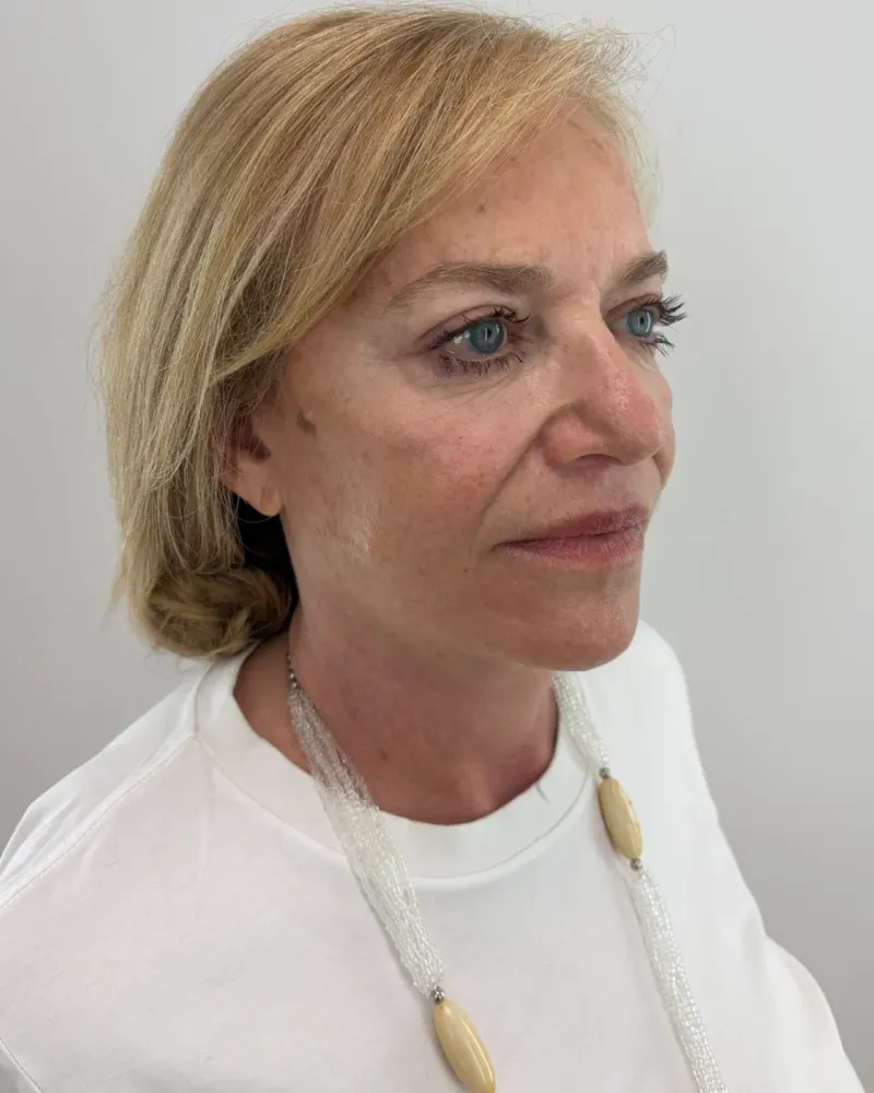 Deep plane λίφτινγκ και lip lift και βλεφαροπλαστική άνω βλεφάρων: 3 έτη μετά την επέμβαση, προφίλ δεξιά – γυναίκα 60–70 ετών