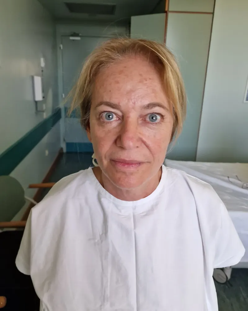 Deep plane λίφτινγκ και lip lift και βλεφαροπλαστική άνω βλεφάρων: πριν την επέμβαση, μπροστά – γυναίκα 60–70 ετών
