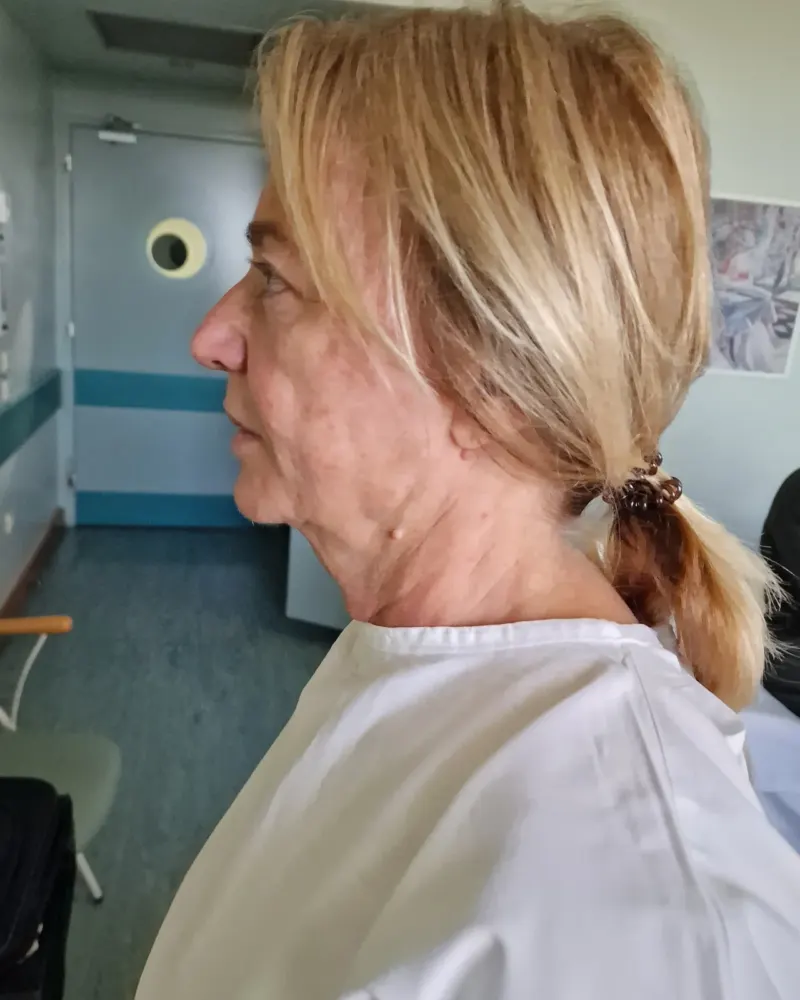 Deep plane λίφτινγκ και lip lift και βλεφαροπλαστική άνω βλεφάρων: πριν την επέμβαση, λοξή αριστερή – γυναίκα 60–70 ετών