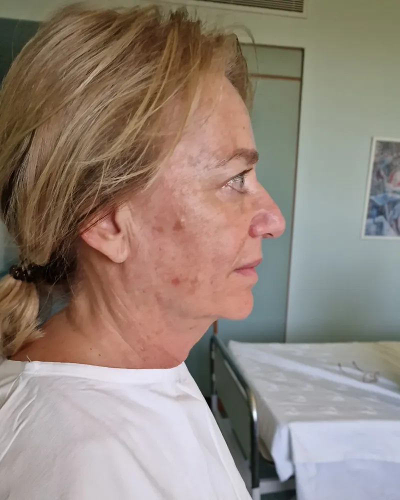 Deep plane λίφτινγκ και lip lift και βλεφαροπλαστική άνω βλεφάρων: πριν την επέμβαση, λοξή δεξιά – γυναίκα 60–70 ετών