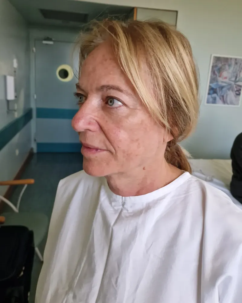 Deep plane λίφτινγκ και lip lift και βλεφαροπλαστική άνω βλεφάρων: πριν την επέμβαση, προφίλ αριστερό – γυναίκα 60–70 ετών