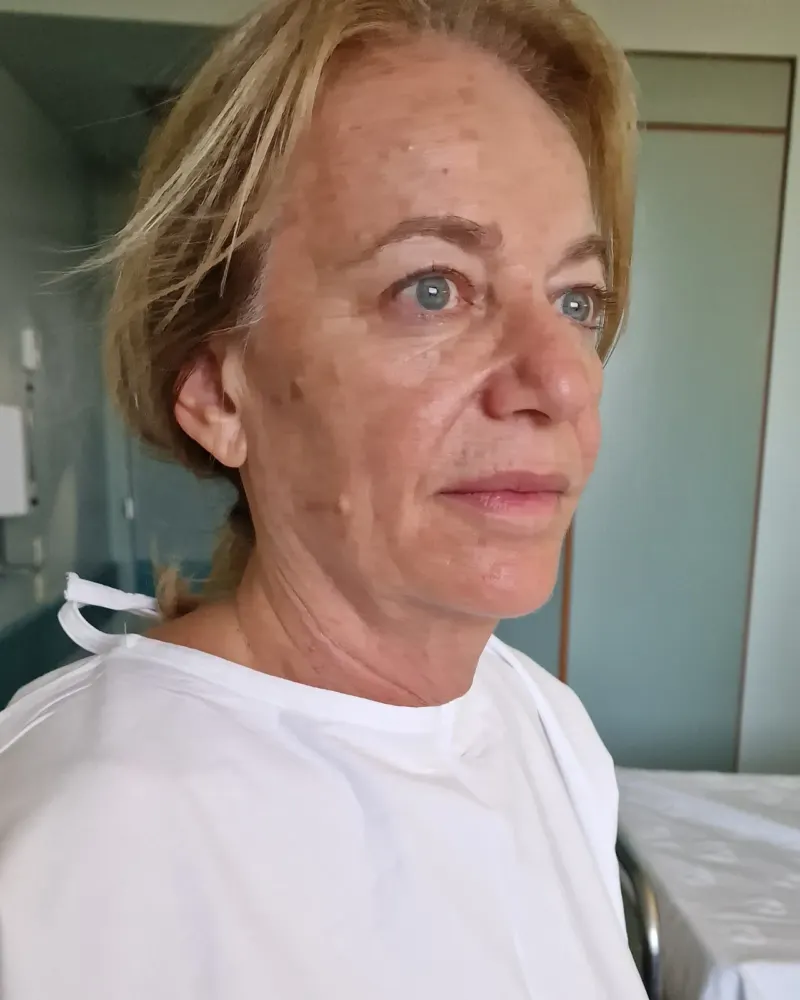 Deep plane λίφτινγκ και lip lift και βλεφαροπλαστική άνω βλεφάρων: πριν την επέμβαση, προφίλ δεξιά – γυναίκα 60–70 ετών