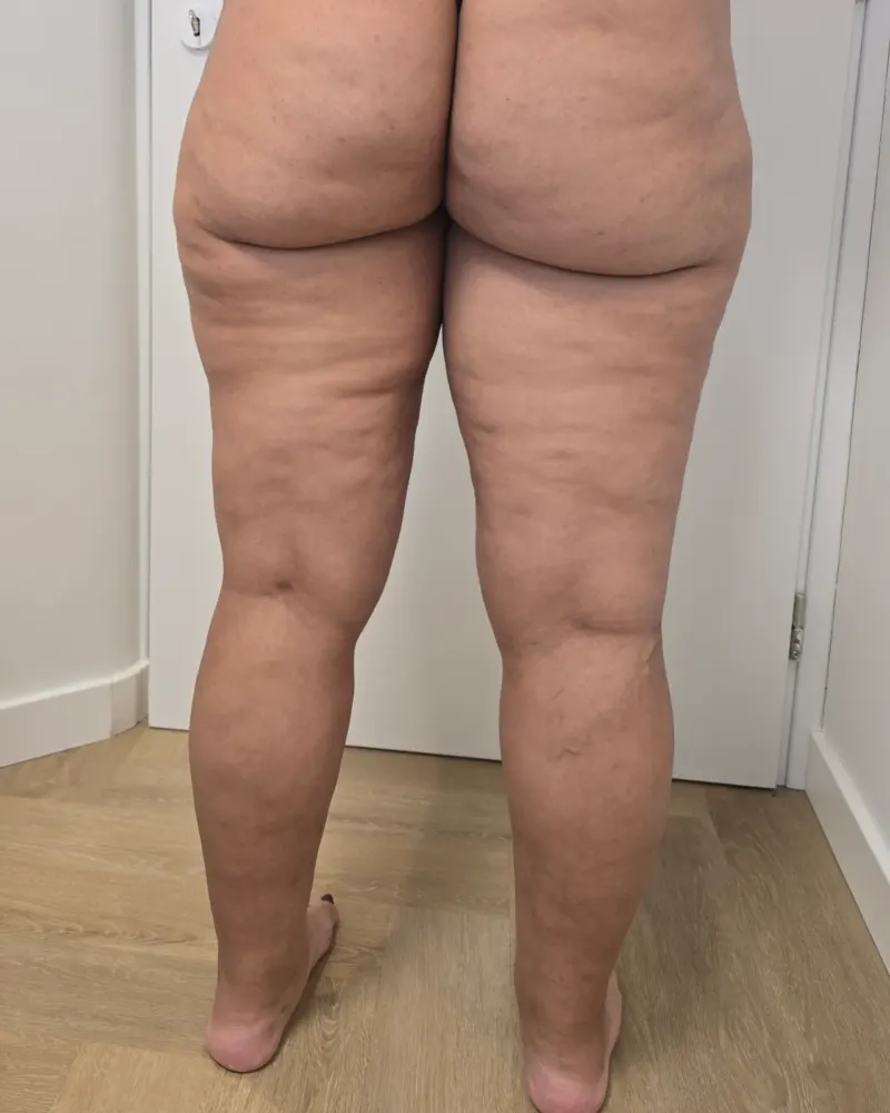 Liposuction for lipoedema and liposuction: 6 months after surgery, back – woman, 25–30