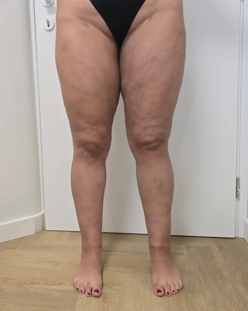 Liposuction for lipoedema and liposuction: 6 months after surgery, front – woman, 25–30