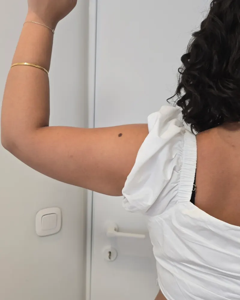Liposuction for lipoedema and liposuction: 6 months after surgery, posterior upper trunk – woman, 25–30