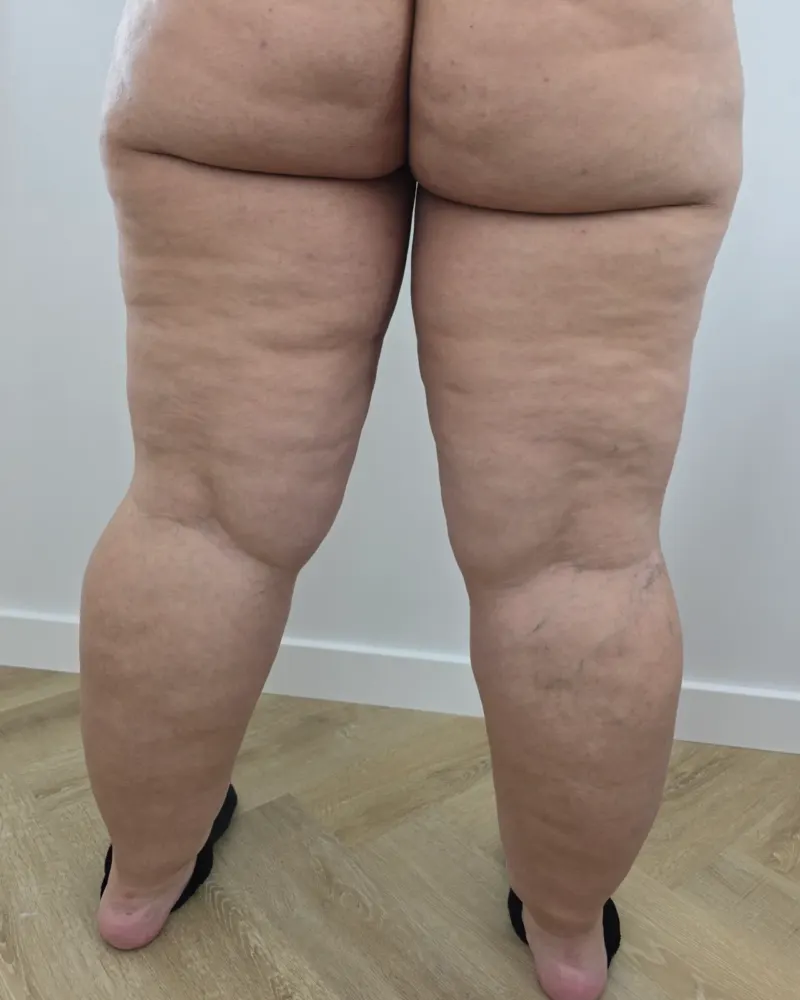 Liposuction for lipoedema and liposuction: before surgery, back – woman, 25–30