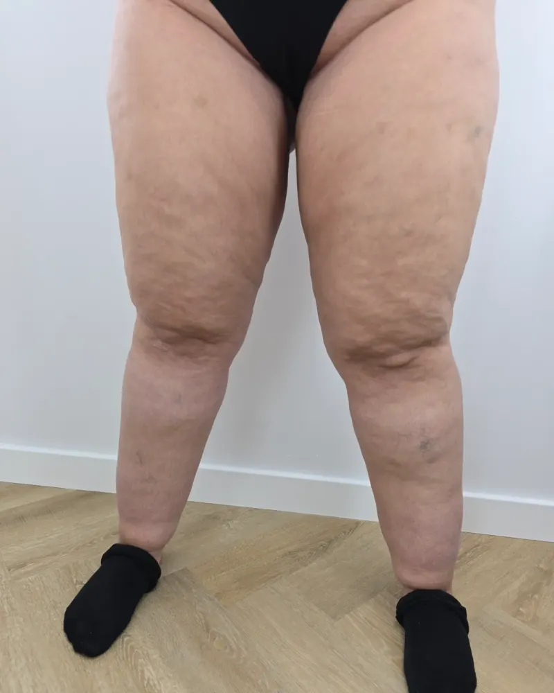 Liposuction for lipoedema and liposuction: before surgery, front – woman, 25–30