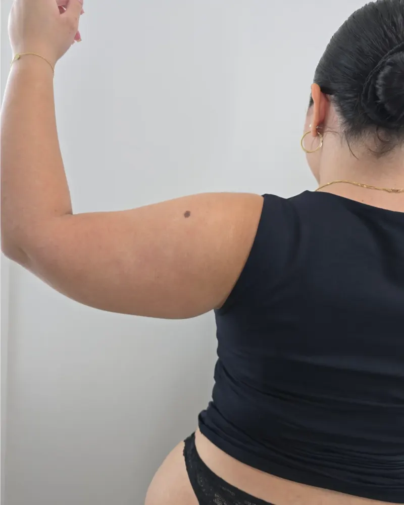 Liposuction for lipoedema and liposuction: before surgery, posterior upper trunk – woman, 25–30