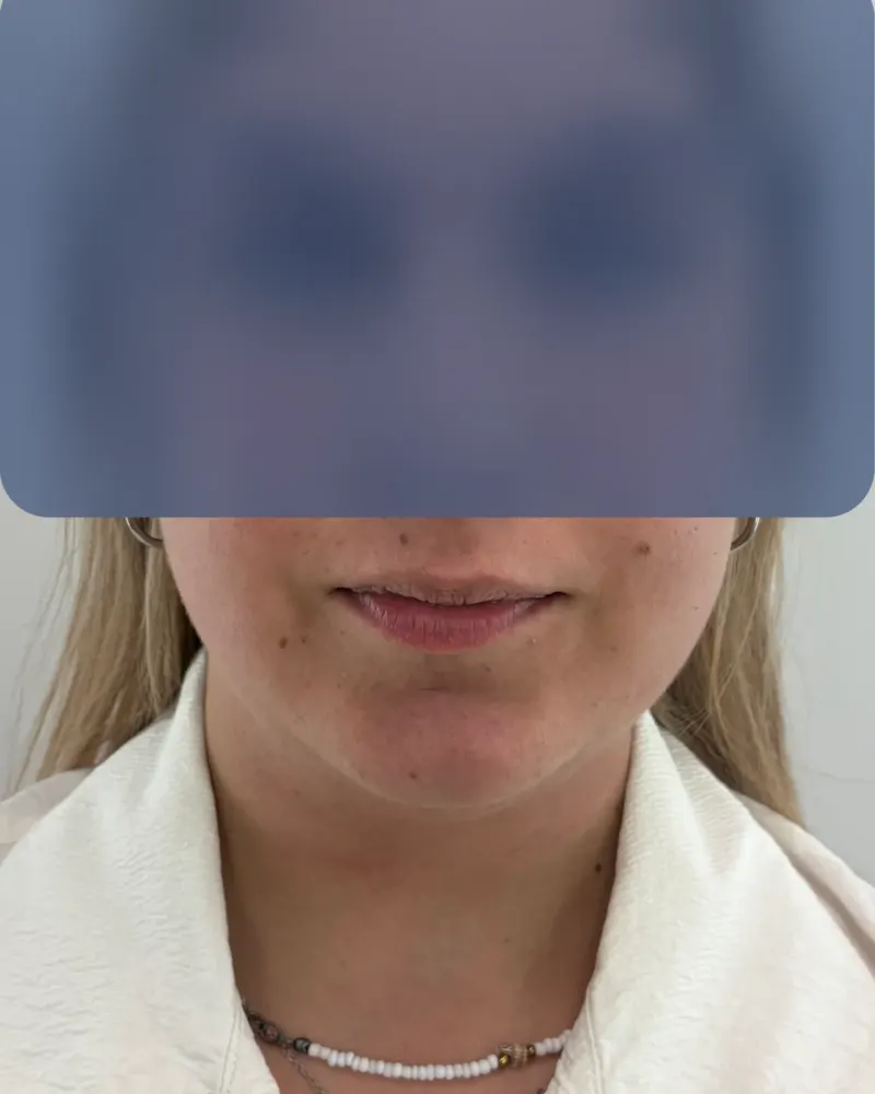 Λιποαναρρόφηση: πριν την επέμβαση, μπροστά – γυναίκα 25–30 ετών